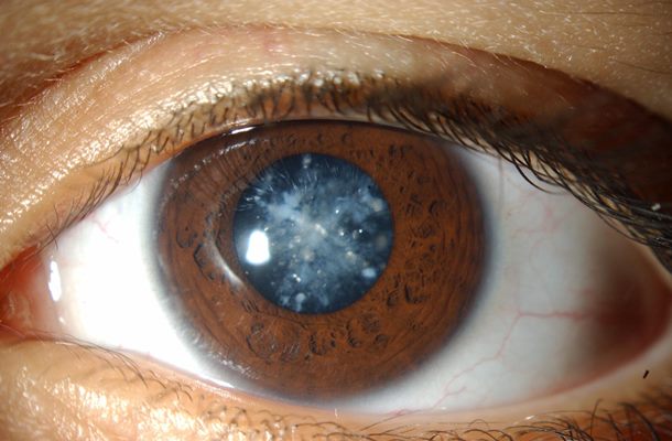 eliminarea cataractei viziune nouă