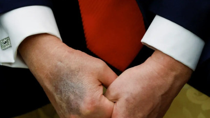 Medicul personal al lui Donald Trump anunță că acesta continuă să se bucure de o sănătate excelentă în ciuda problemelor medicale vizibile