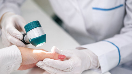 Cum transformă melanomul propriile particule în capcane pentru celulele imunitare