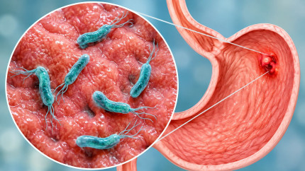 De ce o bacterie aparent banală poate crește riscul pentru cancerul gastric